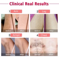 Pulsed laser Hair Removal lazer epilator Epilator for women