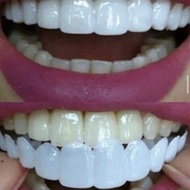 Terbaruuu!!! Ideal Smile Gigi Palsu Atas Bawah Gigi Palsu Instan Lepas