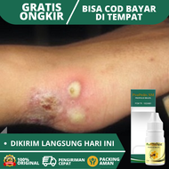 Obat Borok Obat Borok Bernanah Obat Borok di Kepala Obat Borok di Kaki Obat Borok di Tangan Obat Bor