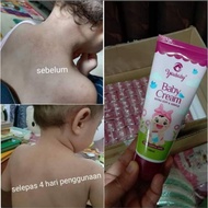 krim ruam ,eczema dan kulit sensitif