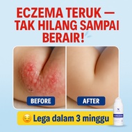 Krim Gatal, Krim Ekzema, Ubat Gatal Kulit Farmasi, Psoriasis, Kulit Gatal Kering & Mengelupas – CURE