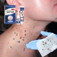 ubat ketuat wart remover buang tahi lalat ubat ketuat tangan skin tag remover corn remover genital w