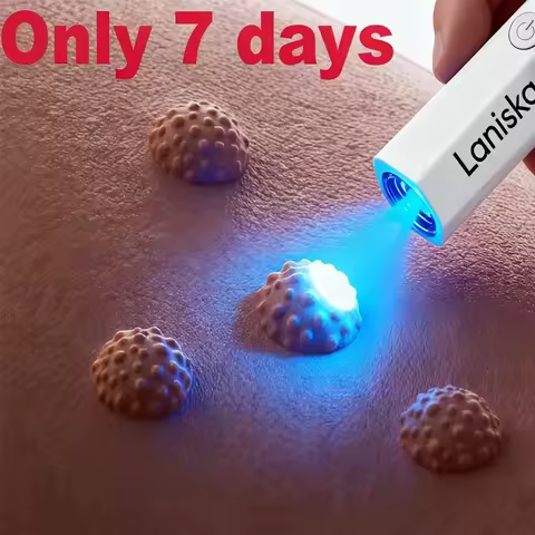 The latest generation of blue light wart removal pen quickly eliminates warts.