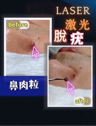 🇭🇰香港【無痛激💥光脫疣 癦 痣 汗管瘤 肉粒】