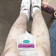100% effective scar removal cream 50g peklat remover legit scars remover original peklat remover old