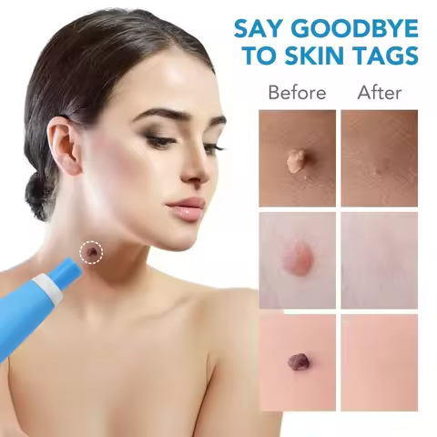New Wart Remover Kit for Flat Plantar Warts & Moles with Liquid Pen and Chicken Eye Treatment Profes