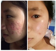 AMOUR ACNE XL SET (เซตใหญ่)