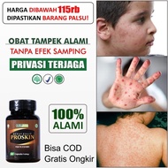 Obat Tampek Pada Anak Campak Dewasa Cacar Air Alami PROSKIN No Mapoh