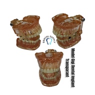 Dental Implant Model (Dental Study MoDel) Transparent