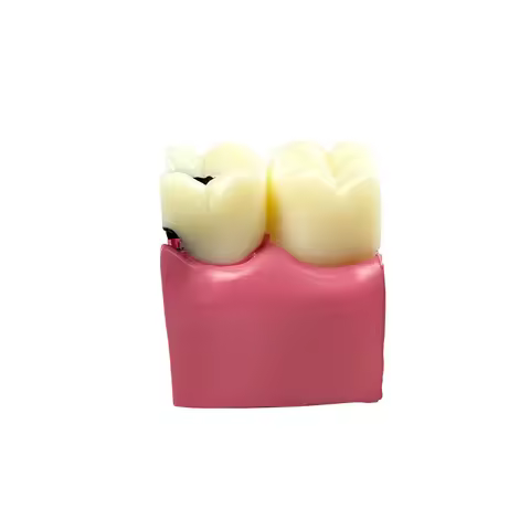 6 Times Dental Caries Teeth Model Pathological Molar Cross Section Model Tooth Decay Comparsion Stud