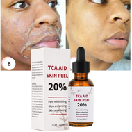 【Hot demand】 20% TCA aid skin peel pores 30ml trichloroacetic acid solution minimizing blackheads so