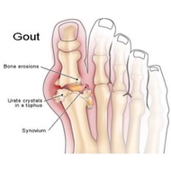 Ubat GOUT HOMEOPHATY