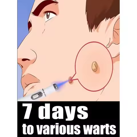 Laser pen wart removal without ʷᵒʳʳʸⁱⁿᵍ ᵃᵇᵒᵘᵗ ⁱⁿᶠᵉᶜᵗⁱᵒⁿ ᵒʳ ⁱⁿᶠˡᵃᵐᵐᵃᵗⁱᵒⁿ