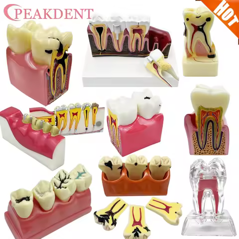 4/6/8 Times Dental Caries Model Disease Teeth Dental Model for Dental Demonstration Model Dentist Te