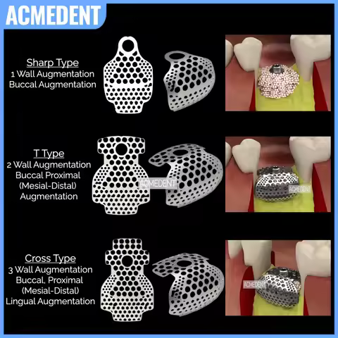 5Pc Dental OB2 GBR 3D Titanium Mesh Guided Bone Regeneration Membrane Plate Implant Bone Formation B