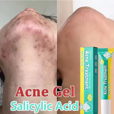 Salicylic Acid Acne Cream Fast Gently Repair Acne Spot Scar Shrinks Pores Gel Brightens Skin Tone Ti