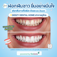 [E-voucher] Deezy Dental Home (Chatuchak Branch) - ฟอกสีฟันที่คลินิก ด้วยระบบ Zoom