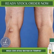 Obat Kista Baker (Bakers cyst) Obat Kista Popliteal Obat Alami Hilangkan Kista Baker Obat Penghilang