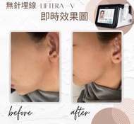 無針埋線 Liftera—V