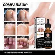 Eelhoe Nail Repair Solution Antibacerial Nail Fungus Treatment Anti Onychomycosis Paronychia Nail Re