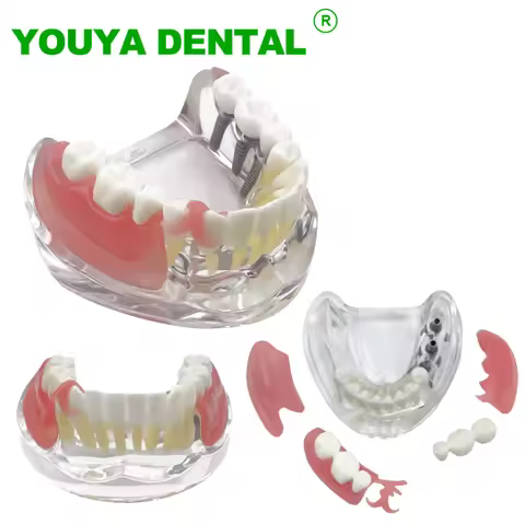Dental Implant Model With Restoration M6006 Overdenture Inferior Demo Mandibular Teeth Model 3 Impla