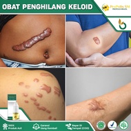 Obat Keloid Menonjol Tahunan - Obat Keloid Daging Tumbuh - Obat Keloid Penghilang Bekas Luka - Obat