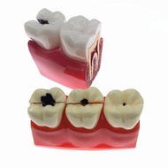 Teeth Model Caries Comparation Study Models 4Times/6times Caries model Teaching research model for d