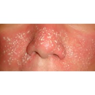 ✿ ♥ ˍ ❧ ♞,♘TCA Peel Solution / TCA Cross 80% 20ml for scars and tattoo removal