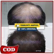 [ C O D ] Obat penumbuh rambut botak dengan cepat Pemanjang rambut tercepat 1 minggu Obat pelurus ra