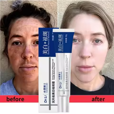 Dr. Li Freckle Whitening Cream Fade Dark Spot Brightening Black Dot Melasma Chloasma Removal Smooth 