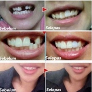 🇲🇾READY STOCK🇲🇾temporary teeth-gigi palsu-5gram