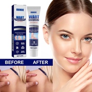 OUHOE Wart Remover Ointment Mole Skin Tag Remover Corn Plaster Antibacterial Foot Wart Genital Wart 