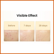 ☀️ ▘ ∵ Safeguard DETOX Acne Soap Dual Use Wash 99.9% Bacteria New Old Packaging Random Chamomile Wh