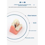 【Fast Shipping】Dental Implant Model Human Oral Teeth Model Transparent Teeth Model Dental Implant Mo