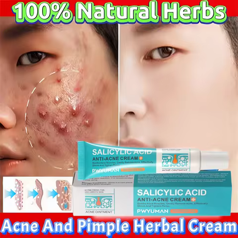 Herbal Acne Removal Face Cream Clears Pimple Scar Black Dots Gel Acne Treatment Shrink Pore Skin Whi