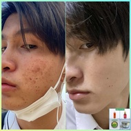Acne Teen Hormonal Inflammation