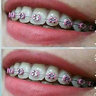 2-color fashion braces
