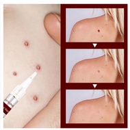 3ml Wart Treatment Pen Skin Tags Moles Remover Warts Corn Remover