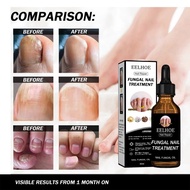 Eelhoe Nail Repair Solution Antibacerial Nail Fungus Treatment Anti Onychomycosis Paronychia Nail Re