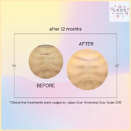 ▤ △ ¤ 10 Sheets of Eclar Plaster Japanese Keloid Scar Remover