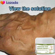 Varicose Vein Cream Effective Varicose Veins Treatment Cream Anti Varicose Veins Ointment 50g Develo