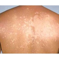 Itchy / Ringworm / PANAU cream