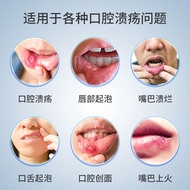 Oral Ulcer Gel Relieve Oral Inflammation Not Bitter Gum Swelling Pain Creation Healing Reduce Pain U