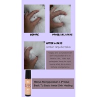 Lansungkirm- Back To Basic Ivette Skin Healing Roll On Medicine for Skin Pain