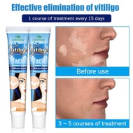 Krim penjagaan kulit menghilangkan vitiligo tompok putih panau kulit badan muka penjagaan kulit wajah
