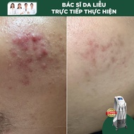 Điều Trị Mụn Bằng IPL (Cơ Bản) (F-AC)