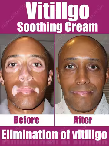 Vitiligo treatment cream White Spot Removal ointment