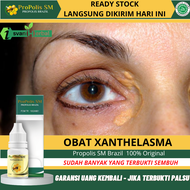 Obat Xanthelasma Obat Penghilang Xanthelasma Obat Gumpalan Lemak di Kelopak Mata Obat Plak Kuning Di