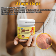 Psoriasis Cream Antifungal cream Eczema cream Cream gatal kulit 20g krim gatal kulit herba cina Ubat