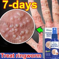 ubat gatal kulit 50ml ubat kurap obat gatal untuk kulit itchy skin psoriasis Spray ubat kudis gatal